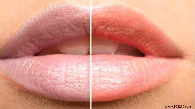 Tobacco Blackened Lips? 3 Remedies To Detach Them In 1 Week. 