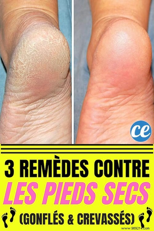 Damaged feet? 3 Remedies for Dry, Swollen and Cracked Feet. 