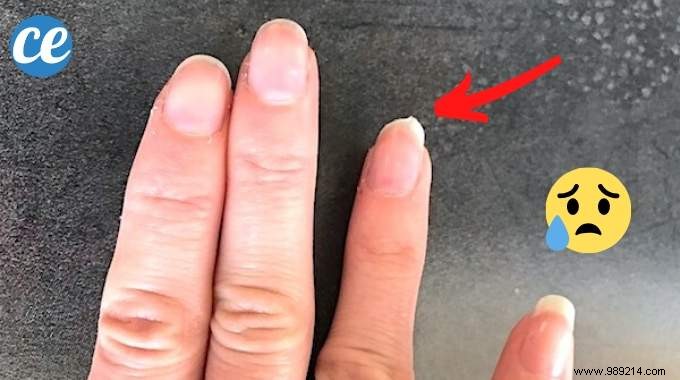 Brittle nails? The Miracle Remedy For UNBREAKABLE Nails! 