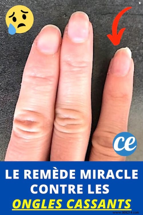 Brittle nails? The Miracle Remedy For UNBREAKABLE Nails! 