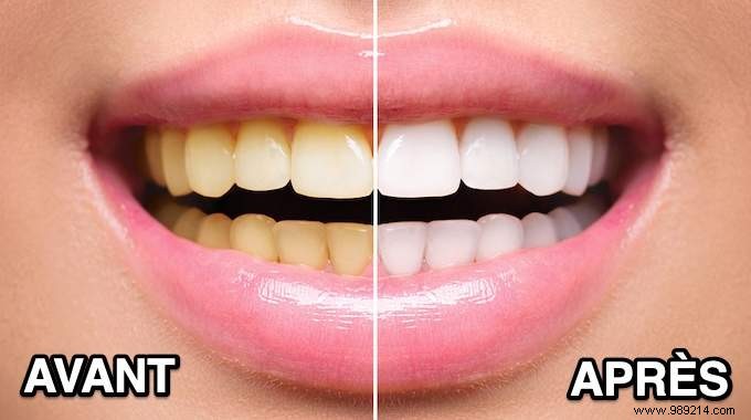 How To Whiten Your Teeth Naturally In Just 1 Day. 