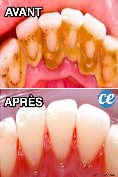 3 Amazing Tips To Remove Dental Tartar By Yourself. 