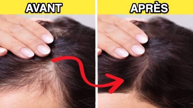 10 Natural And Effective Remedies To Regrow Your Hair. 