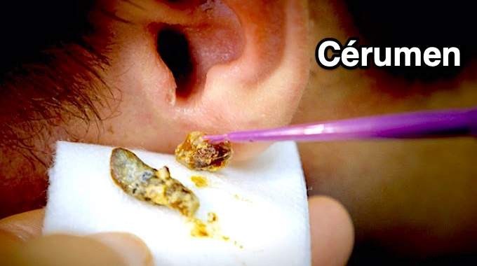 How to Remove an Earwax Blockage? The Natural &Effective Remedy. 