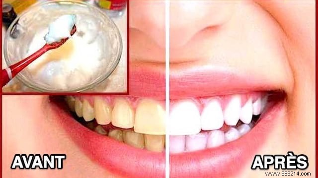 How To Get Snow White Teeth In No Time. 