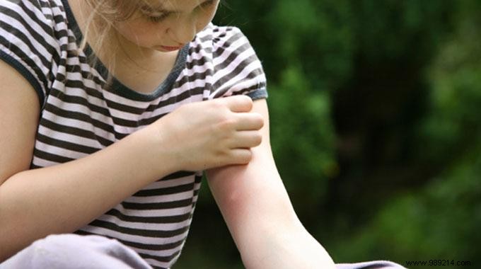 The 6 Natural Remedies To Treat A Mosquito Bite. 