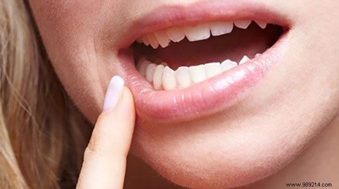 A Mouth Ulcer? Salt Treatment:An Effective Remedy. 