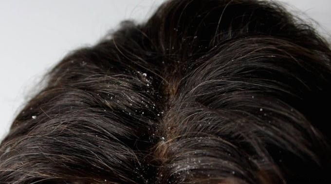 The New Dandruff Remedy You Need To Try. 