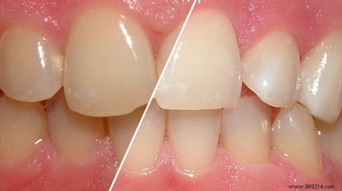 The New Trick To Prevent Teeth From Yellowing. 