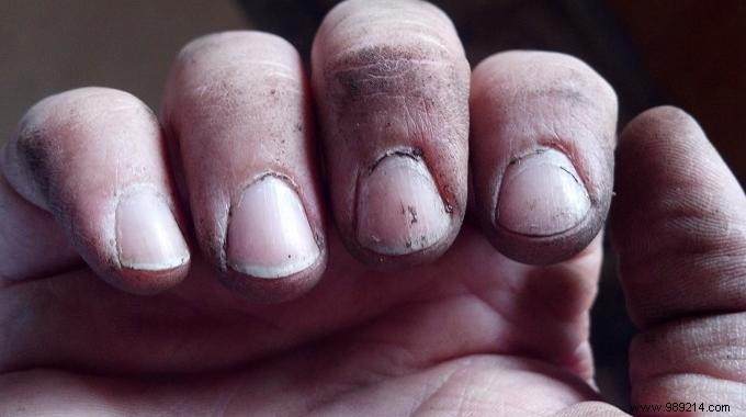 Do You Have Dirty Black Nails? Here is the Tip To Clean Them Easily. 