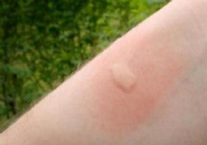 The Magic Trick To Quickly Calm A Mosquito Bite. 