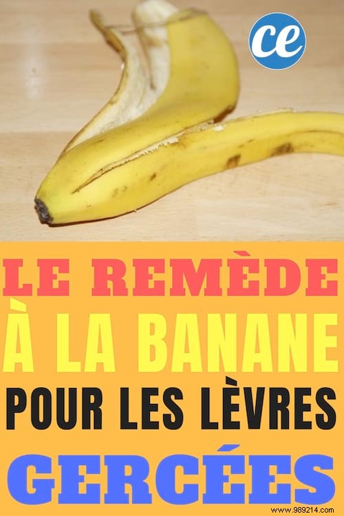 My Banana Remedy For Dry, Chapped Lips. 