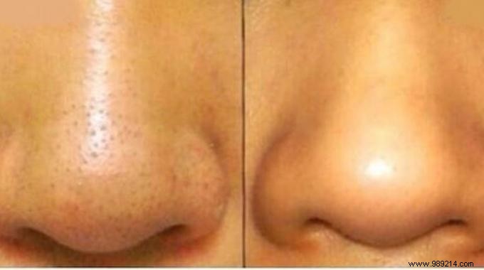 Finally a remedy that works for removing blackheads. 