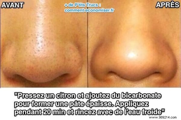 Finally a remedy that works for removing blackheads. 