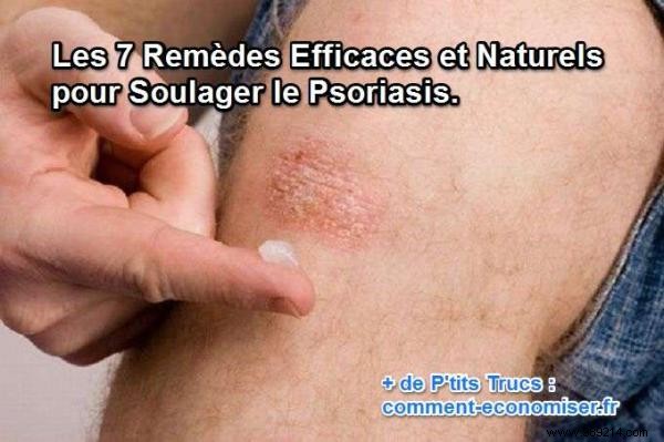 The 7 Effective and Natural Remedies to Relieve Psoriasis. 