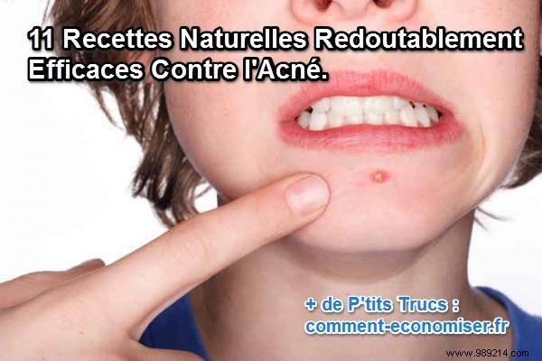 11 Natural Recipes Formidably Effective Against Acne. 