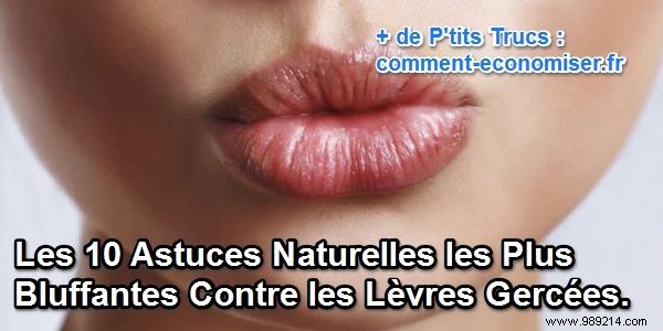The 10 Most Amazing Natural Tips Against Chapped Lips. 