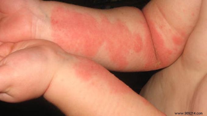 My Little Tips To Relieve Eczema. 