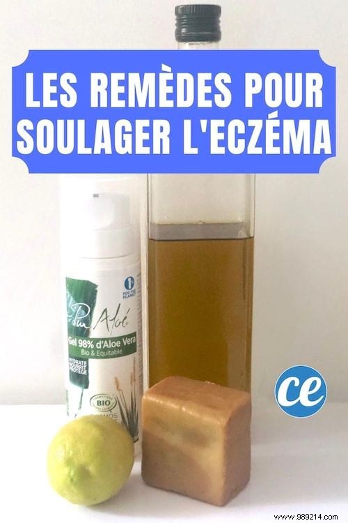 My Little Tips To Relieve Eczema. 