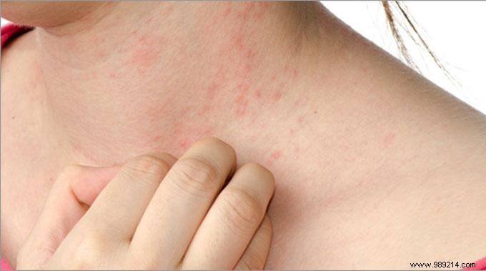 The Magic Remedy to Relieve Eczema Naturally. 