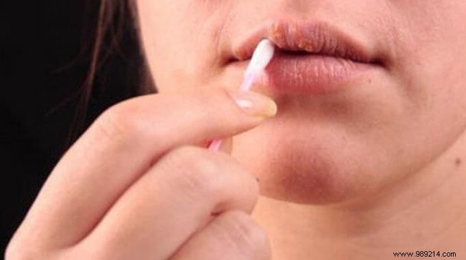 Oral Herpes:The Remedy That Works To Cure It Fast. 