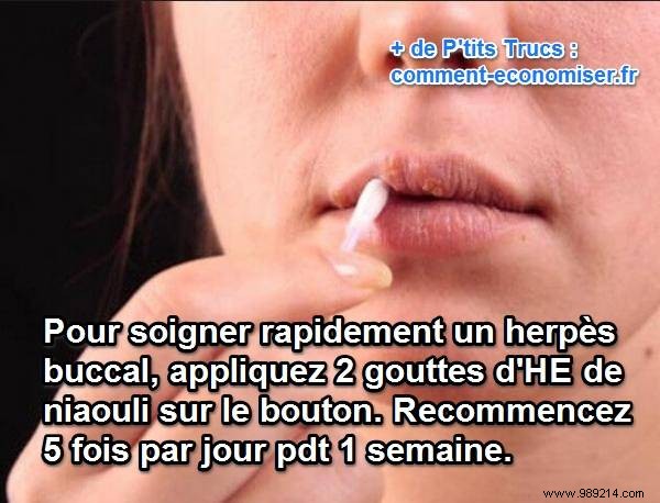 Oral Herpes:The Remedy That Works To Cure It Fast. 