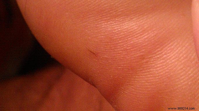 How to Remove a Splinter in the Foot, Finger or Hand? 