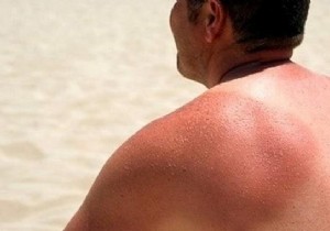 The Easy Homemade After-Sun Recipe. 