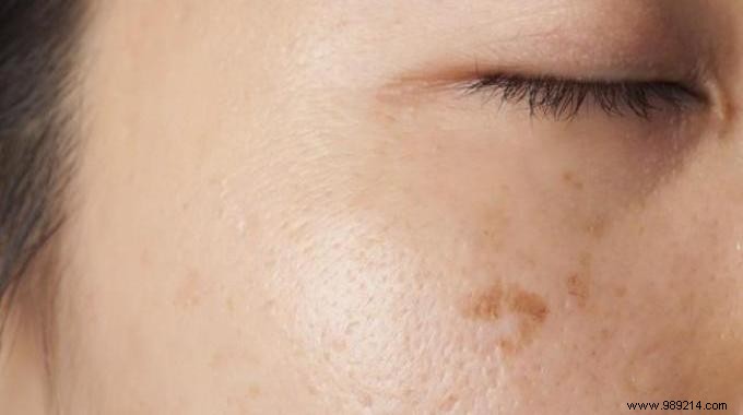 13 Natural and Effective Remedies for Dark Spots on Skin. 