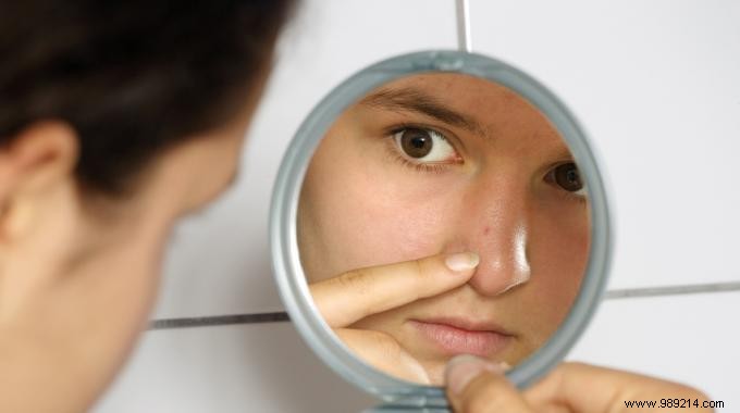 Teen Special:Treat your Acne Pimples with Bicarbonate! 