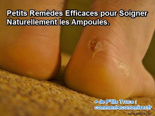 Small Effective Remedies to Cure Blisters Naturally. 