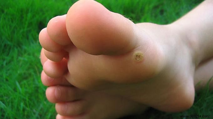 How To Cure A Wart With Just Garlic. 