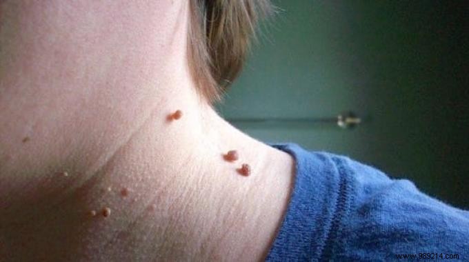 Skin Tags:How to Make Them Disappear with Apple Cider Vinegar. 