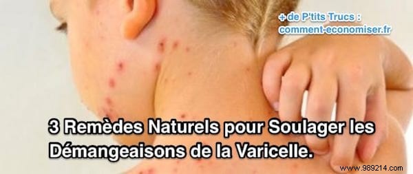 3 Natural Remedies to Relieve Chicken Pox Itch. 