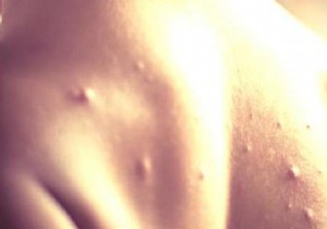 3 Natural Remedies to Relieve Chicken Pox Itch. 