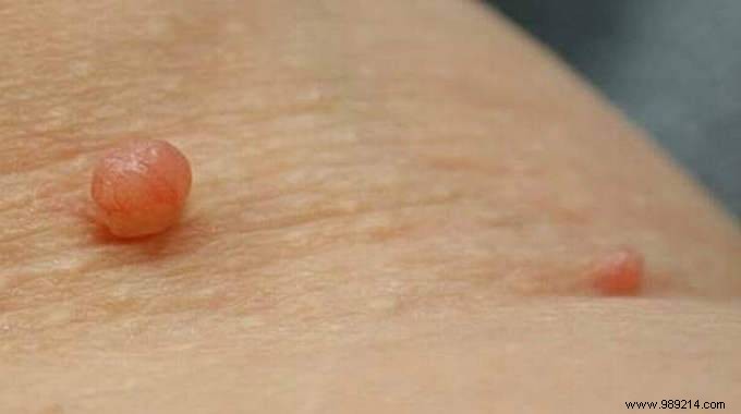 How to remove a skin tag quickly with essential oil. 