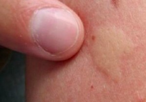 12 Super Effective Remedies To Relieve A Mosquito Bite Instantly. 