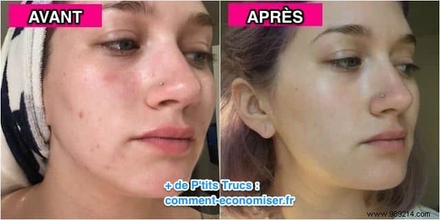 How to Get Rid of Acne Pimples With Essential Oil? 