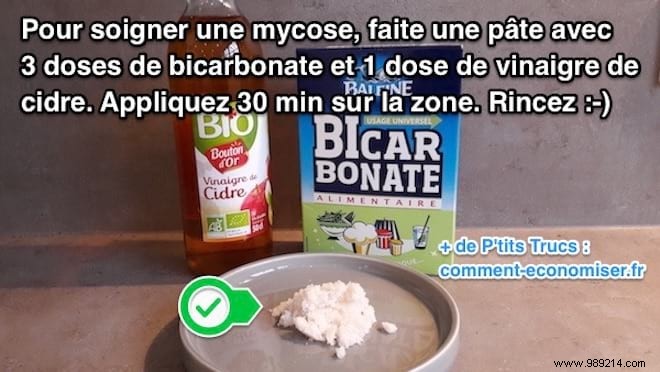 Bicarbonate + Cider Vinegar:The Magic Remedy Against Mycosis. 
