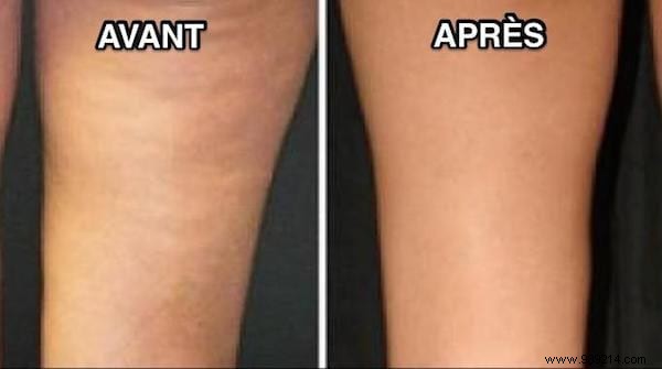 16 Magical Remedies To Get Rid Of Cellulite. 