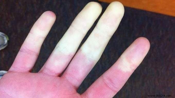 Raynaud s Disease:The Really Effective Remedy To Stop Suffering From It! 