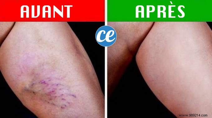 10 Miracle Remedies To Make Varicose Veins Disappear Naturally. 