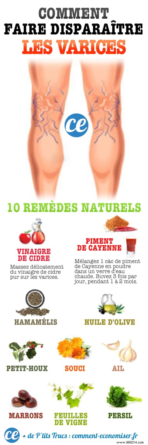 10 Miracle Remedies To Make Varicose Veins Disappear Naturally. 