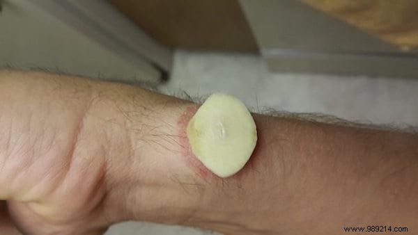 The Ancestral Remedy To Remove A Wart With Garlic (Quickly!). 