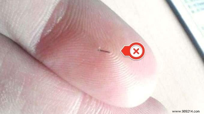 How to Remove a Sunken Finger Thorn EASILY. 