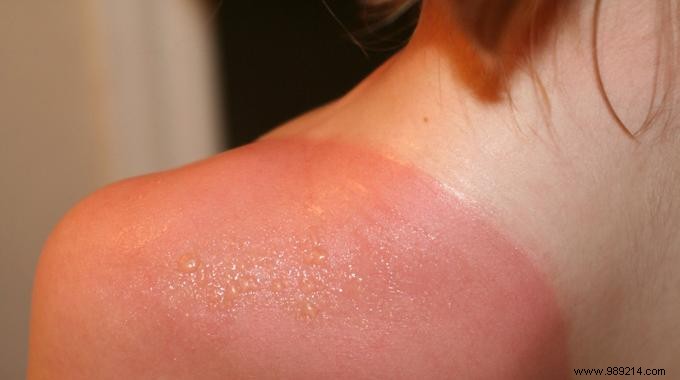 What to do against a sunburn? The Fastest Treatment You Know. 