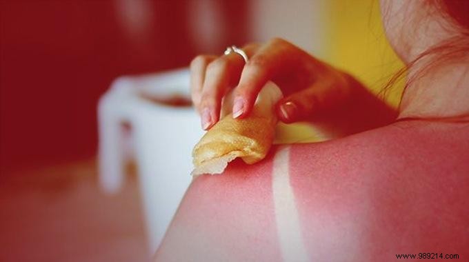 Are Your Sunburns Hurting You? Relieve them Quickly with this Natural Tip. 
