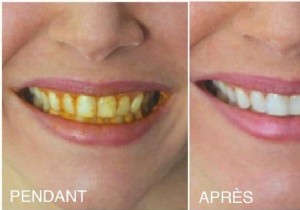 How To Whiten Yellow Teeth With Turmeric (100% Natural And Effective). 