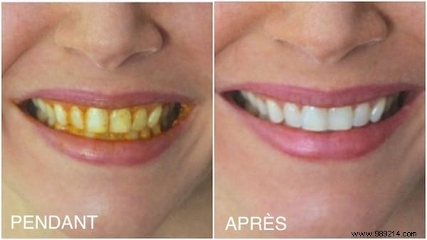How To Whiten Yellow Teeth With Turmeric (100% Natural And Effective). 