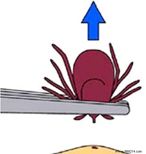 The One And Only Way To Remove A Tick WITHOUT Risk To Your Health. 